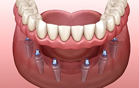Digital illustration of an implant denture