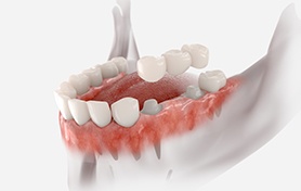 Digital illustration of an dental bridge