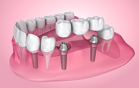 Illustration of an implant bridge