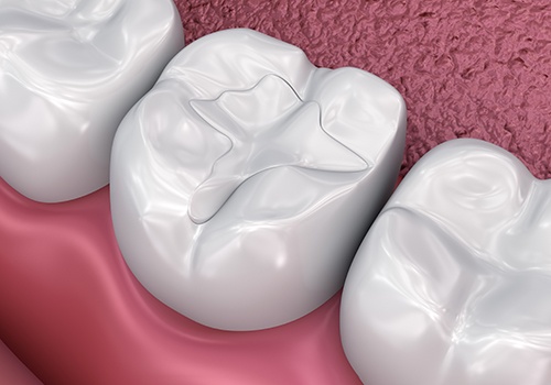 A 3D illustration of tooth-colored fillings