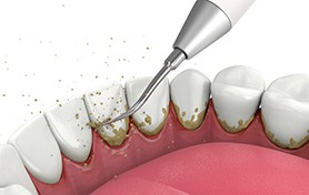 Illustration of dental scaler cleaning teeth