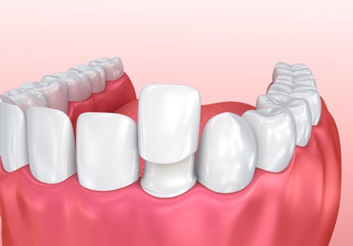 Example of a dental crown from Complete Dental Care Paradise Valley