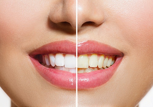  Closeup of a smile that’s half whitened to show before/after results