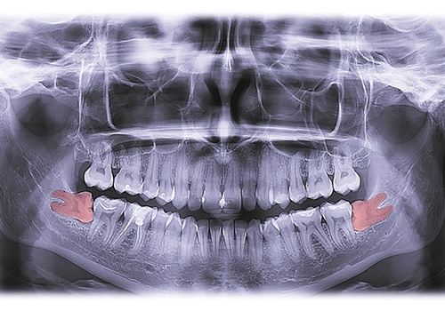 X-ray with wisdom teeth growing in sideways